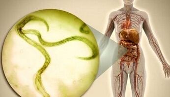 Cómo deshacerse de los parásitos en el cuerpo