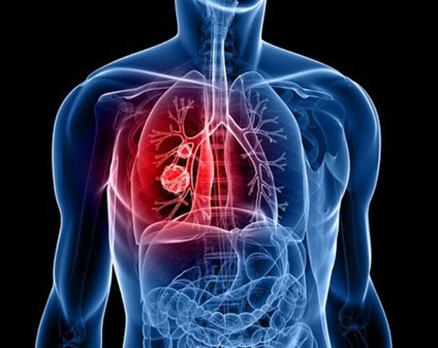 Parásitos en los pulmones.