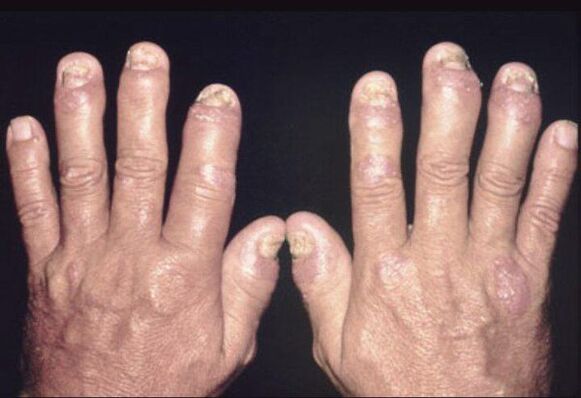 en las articulaciones